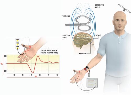 Figure 1 Stimulation and recording techniques for SAI measurements.Notes: The TMS coil is positioned tangentially to the central sulcus over the left M1. Magnetic field inducing an electric field depolarizes pyramidal neurons in the M1 cortex with activation of the corticospinal system. The MEP responses were recorded from hand muscle (APB). Single MEP response from APB muscle is depicted on the EMG channel. The stimulating electrode was positioned over the median nerve at the wrist.Abbreviations: APB, abductor pollicis-brevis; EMG, electromyography; M1, primary motor cortex; Ch1, Ch2, Channels; GND, Ground.