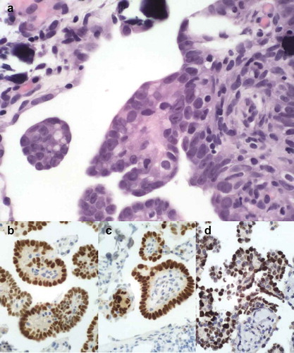 Figure 1. Histological and immunohistochemical images of the tumor, consistent with high grade papillary serous carcinoma. The tumor showed a typical morphology with numerous papillary formations and psammoma bodies. The tumor cells are atypical with irregular nuclei and macro-nucleoli (A). They stain positive for the estrogen (B) and progesterone receptors (C) and for PAX8 (D) .