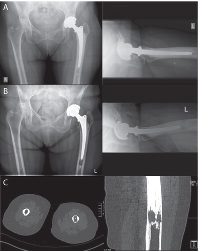 Figure 4. A. An 84-year old woman immediately postoperatively with an unremarkable cemented prosthesis. B. 2 years after implantation, a discrete osteolysis was found distal to the prosthesis. C. The amount of osteolysis as seen in a CT. In a standard radiograph, there might be underestimation of the amount of loosening, which we noted often shows in an anterior-posterior pattern, weakening the linea aspera.