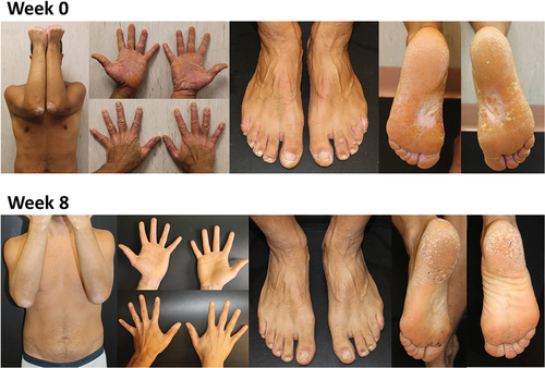 Figure 2. Changes in psoriasis skin lesions during treatment with secukinumab: case 1.