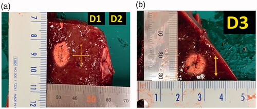 Figure 2. Measurement of the ablation zone. Photographs of specimen created by radiofrequency ablation with thyroid-dedicated internally-cooled wet electrode in the electrode insertion axis. (A) The maximum vertical diameter (D1) along the electrode and the perpendicular transverse diameter (D2) were measured. (B) The second transverse diameter of the ablation zone (D3) was measured in the perpendicular plane to the plane passing through the axes of the probe.