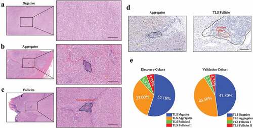 Figure 1. The classification of tertiary lymphoid structure (TLS) in primary GIST