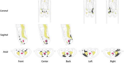 Figure 3. Cross-sections of the threshold SAR distributions for different phase settings for patient I. Regions with SAR levels above the 90% SAR percentile for synchronous settings are colored dark grey. Bone and target are indicated in yellow and magenta, respectively. For all steering directions, a positive phase difference of 120° is applied in the direction indicated at the bottom.
