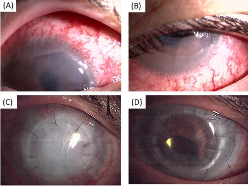 Figure 3. Ocular findings. (A, C) Patient’s right eye, (B, D) patient’s left eye. (A, B) Anterior segment image at 26 days after the chromium exposure shows corneal neovascularization and conjunctiva invasion into cornea. (C) Postoperative anterior segment image of deep anterior lamellar keratoplasty and corneal limbal transplantation. (D) Postoperative anterior segment image of full-thickness penetrating keratoplasty and corneal limbal transplantation.