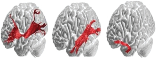 Figure 2 Left illustration depicts the direct pathway from the posterior cortices to the prefrontal cortex. The inferior occipitofrontal fasciculus connects the posterior temporal areas and the orbital and lateral prefrontal regions. Middle illustration consists of the first segment of the indirect pathway. The inferior longitudinal fasciculus links the posterior occipitotemporal regions with the temporal pole and this fiber tract courses underneath the inferior occipitofrontal fasciculus. Right illustration depicts the second component of the indirect pathway. The uncinate fasciculus connects the anterior and medial temporal lobe with the orbitofrontal regions. Copyright © 2005, Oxford University Press. Adapted with permission from CitationCatani M, ffytche DH. 2005. The rises and falls of disconnection syndromes. Brain, 128:2224–39.