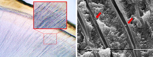 Figure 5. Bacterial invasion in dentinal tubules under intact but hypomineralized enamel. In sections near the cuspal parts of the hypomineralized enamel, the dentinal tubules showed bluish staining, indicating the presence of Gram-positive bacteria. The SEM observation revealed severely contaminated dentinal tubules. (×40 magnification and ×4000).