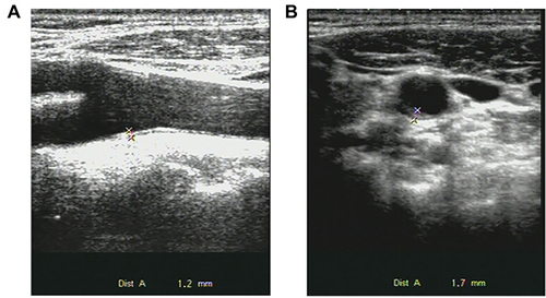 Figure 1 (A) Sagittal scan of carotid ultrasonogram. (B) Longitudinal scan of carotid ultrasonogram. Measurement of IMT (*) at posterior wall of carotid artery bifurcation is shown.