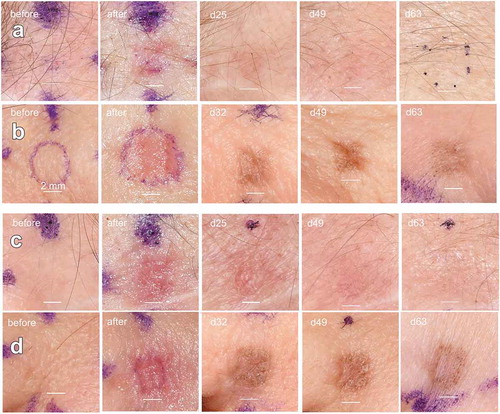 Figure 2. Long-term images of facial skin treated with NPS energy. (a) Fitzpatrick type 1 skin treated with 150 mJ/mm3; (b) Fitzpatrick type 2 skin treated with 150 mJ/mm3. (c) Fitzpatrick type 1 skin treated with 300 mJ/mm3; (d) Fitzpatrick type 2 skin treated with 300 mJ/mm3. The scale bars in each image are 2 mm long and the day after treatment on which each photo was taken is indicated in the upper left of each photo