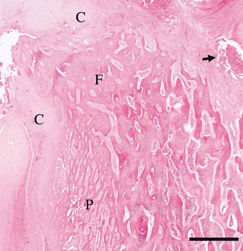 Figure 5.  Histology of the left femoral head of a juvenile YEP with bilateral coxofemoral degenerative joint disease (haematoxylin and eosin), with the remains of the proximal femoral head at the top left (F). The articular cartilage is absent, and much of the normal epiphyseal bone has been resorbed. The remaining trabecular bone is covered by a thick layer of mature lamellar collagen (C). Fibrin and cellular debris occupy pockets within the remaining joint space (arrow). Note the florid periosteal reaction that forms delicate trabeculae which protrude nearly perpendicularly from the periostium (P). Scale bar = 1000 µm.