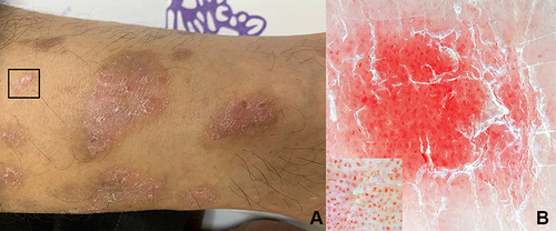 Figure 6 (A) Clinical image of psoriasis, square indicates (B) dermoscopic image showing bright red background, diffuse scales, and glomerular vessels in regular distribution (x10 original magnification and inset x50 original magnification).
