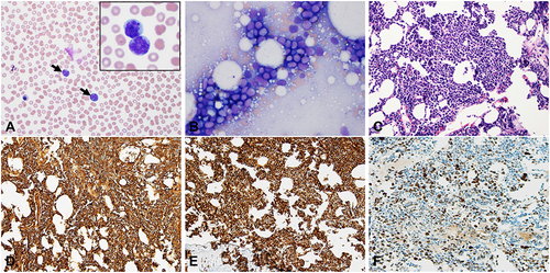 Figure 3 Peripheral Smear and Bone Marrow Biopsy Case #2. For case #2, circulating atypical large lymphocytes (arrows) were present in the peripheral blood smear (A, WG stain, x 40; inset x 60). The roll prep smear and bone marrow biopsy revealed diffusely infiltrating lymphoma cells (B, WG stain x 40; C, H&E stain x 20). IHC showed the lymphoma cells were positive for CD79a and CD10 with a high proliferative rate by Ki-67 (80%) (D, E, F, x 20).