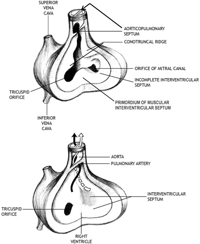 Figure 1. Division of the outflow tract by the aorticopulmonary (spiral) septum. In the top diagram, the aorticopulmonary septum is forming by the growth and merging of the conotruncal ridges in the walls of the outflow tract. This process divides the outflow tract into the atrioventricular canals (precursors of the aorta and pulmonary artery). In the lower diagram, the spiral septum has completed the separation of the outflow tract into the equally sized aorta (for systemic circulation) and pulmonary artery (for the pulmonary circulation). The most inferior part of the spiral septum will contribute to the upper membranous portion of the IV septum. (Modified from DeSesso & Venkat, Citation2010).