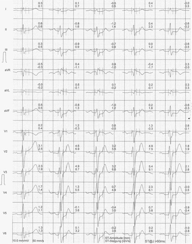 Figure 2 Exercise ECG from brother A.