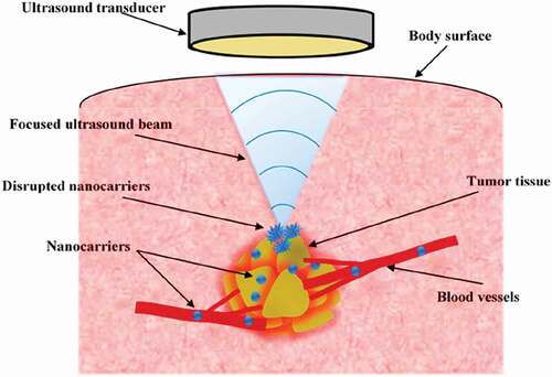 Figure 7. Ultrasound-triggered drug release from targeted nanoparticles. The controlled ultrasound beam is focused on the tumor tissue; nanocarriers passing through the high-intensity focused beam are disrupted or activated. Reproduced with permission from [Citation116].Table 1 illustrates the various Carbohydrate based stimuli-responsive nanocarriers for cancer treatment.