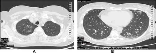 Figure 3 Chest CT images after three months showing complete resolution with mild fibrosis. (A) Complete resolution in the supraclavicular area. (B) Same result in the right lung included in the tangential radiation fields; no opacities in both lungs.