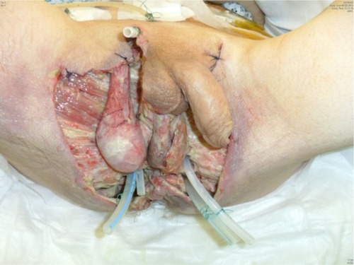 Figure 5 The wound care: debridement – shown is the 11th day post-surgery.