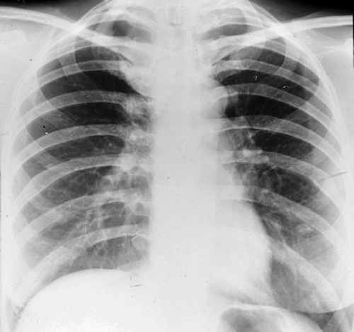 Figure 12.  The same patient as in Figure 11 after hypophysectomy demonstrating regression of the metastases.