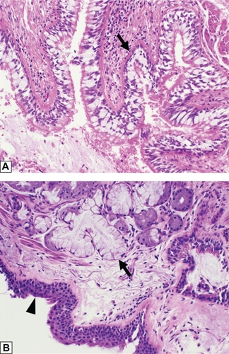 Figure 1 Histologic features of chronic bronchitis. (A) A section of bronchiole wall with luminal accumulation of mucous, goblet cell hyperplasia, basement membrane thickening (arrow), and scattered mononuclear inflammatory cells. (B) A bronchial wall with squamous metaplasia of the luminal epithelium (arrow head) and hyperplasia of the subepithelial seromucinous glands (arrow).