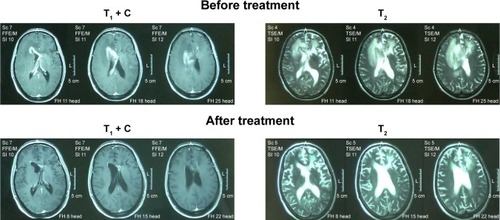 Figure 1 The representative magnetic resonance imaging images of complete response patient before and after the pemetrexed treatment.