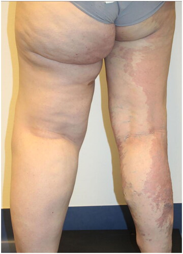 Figure 1. Standing posterior view of the patient before any surgical interventions.