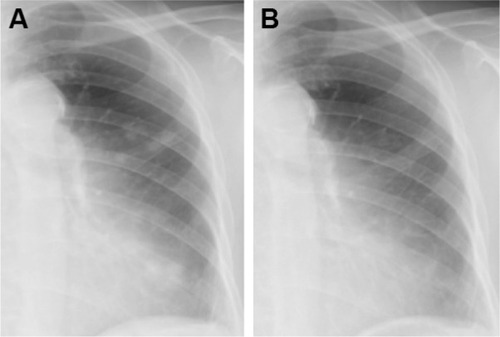 Figure 2 Chest X-rays obtained (A) before and (B) after alectinib therapy.