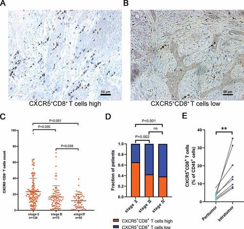 Figure 1. Intratumoral CXCR5+CD8+ T cell infiltration correlates with tumor stage.