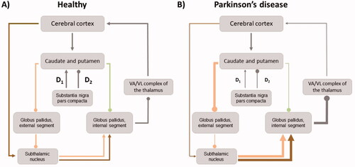 Figure 1. Schematic diagram of basal ganglia circuitry in healthy (A) and PD patients (B). Arrows indicate excitatory projections, dots inhibitory projections, their respective width indicates the relative strength of these projections. Green: direct pathway; orange: indirect pathway; brown: hyperdirect pathway; grey: ubiquitous projections.