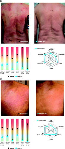 Figure 8. Examples of patients treated with dupilumab monotherapy and their individual improvement in SCORAD outcomes. Photos correspond to the target lesion assessed for SCORAD in SOLO studies (dupilumab monotherapy) in q2w group (approved dose). (a) 64-year-old patient, AD for 19 years; (b) 25-year-old patient, AD for 18 years. The spider graphics show LS mean percent reduction in each outcome; lines closer to the outer edge of the spider plot represent greater improvement from baseline. The rainbow graphics display change in LS mean absolute values from baseline (diamond) to Week 16 (dot) for each outcome. BSA: body surface area; LS; least squares; q2w: every 2 weeks; SCORAD: SCORing Atopic Dermatitis; o-SCORAD: objective SCORAD; VAS: visual analog scale.