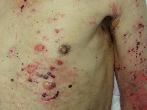 Figure 6 Bullous pemphigoid showing tense blisters, erosions and erythema in a patient with lung cancer under nivolumab.