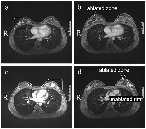 Figure 2. CEMRI images of a 27-year-old woman with bilateral breast fibroadenomas. Before HIFU, T1-weighted fat-suppressed CEMRI images showed hyperintensity masses in the right breast (a) and the left breast (c). The day after HIFU, CEMRI images showed nonperfused ablated zones in the right breast (b, white arrow) and the left breast (d, white arrow). A rim of enhancing tumor in the bottom section of one fibroadenoma in the left breast was shown in the CEMRI images (d, red arrow).