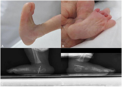 Figure 6. Foot images of a fetus with bilateral CVT, and X-ray images of a fetus feet with unilateral isolated CVT. (A, B) The images show the gross specimen of a fetus with bilateral CVT after induction. (A) The image shows CVT fetus with convex plantar surface, and the hindfoot was in fixed equinovalgus, forming a rocker-bottom foot deformity. (B) The image shows the forefoot was abducted in dorsiflexion. (C, D) The images show bipedal X-ray comparison of a three-month-old child with unilateral CVT. (C) The long axis of the left talus is almost perpendicular to the ground. (D) The long axis of the right talus is almost parallel to the ground (The white line shows the long axis of the talus).