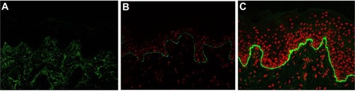 Figure 3 Immunofluorescence mapping of dystrophic epidermolysis bullosa with antibodies to type VII collagen.