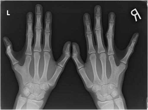 Figure 2. Preoperative radiographs of the patient’s left and right hands.