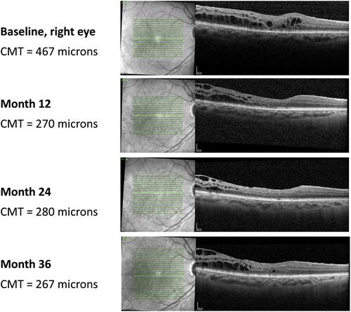 Figure 4 OCT foveal B-scan from baseline to Month 36.