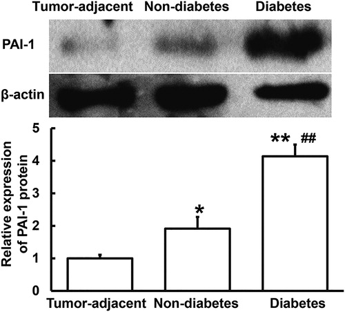Figure 2. Relative expression of PAI-1 protein in tumor tissues from PC patients with or without diabetes and tumor-adjacent tissues from all PC patients. Western blotting was used to determine the expression of protein in tissues. *p < 0.05 and **p < 0.01 compared with tumor-adjacent tissues. ##p < 0.01 compared with tumor tissues from PC patients without diabetes.