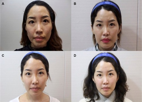 Figure 1 Treatment of periorbital, nasolabial, and submalar regions with CaHA filler results in volume augmentation and skin texture improvement.