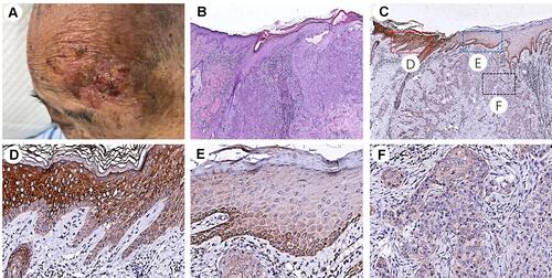 Figure 1 (A, B) Clinical and histopathological findings of CSCC (HE×20). (C) Immunohistochemical staining of HSP 105 (×20). (D) HSP105 is highly expressed in spiny cells but not in basal cells of normal epidermis next to CSCC (×200). (E) The expression of HSP105 in CSCC was lower in spiny cells and positive expression was found in basal cells. (F) HSP105 is expressed at low levels in CSCC in the dermis (×200).