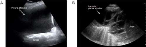 Figure 5 Types of pleural effusion seen on lung ultrasound. (A) Hypoechoic fluid visualized above the diaphragm representing a large simple pleural effusion. The spine is seen extending above the diaphragm. (B) A loculated pleural effusion with septations and heterogenous fluid visualized above the diaphragm.
