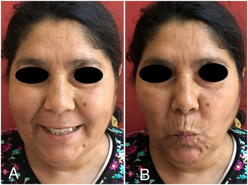 Figure 4. Images of the patient three months after surgery. (A) Smiling. (B) Whistling.