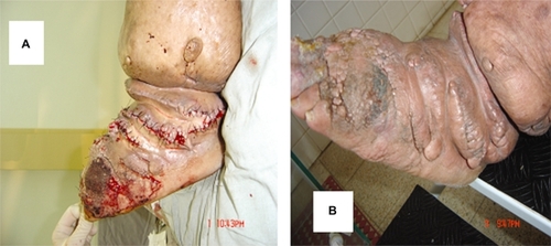 Figure 4 The immediate postoperative period after resection of 2970 grams of tissue and three monts after surgery.