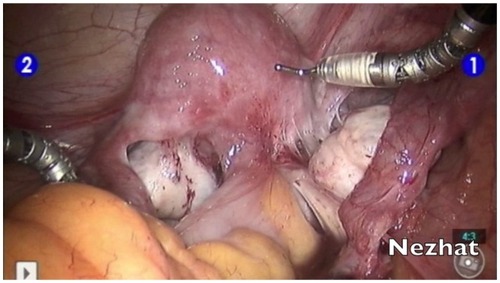 Figure 4 Robotic assistance in the management of deep infiltrating endometriosis.