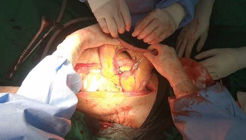 Figure 4 The mesenteric avulsion of the jejunum with active bleeding from the mesenteric vessels.