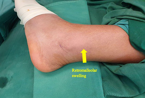 Figure 1 Clinical photograph of left ankle showing swelling on posterolateral aspect of the ankle.