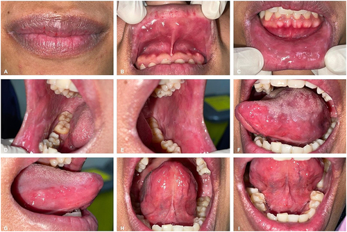 Figure 2 The clinical condition of the patient at the second visit (7 days of therapy): (A and B) the lips of the patient and the upper labial mucosa were healing; (C–I) lower labial mucosa, buccal mucosa, lateral and ventral tongue, and floor of the mouth had undergone improvement.