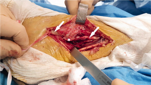 Figure 4. Tibialis posterior tendon identification above and below the medial malleolus (arrows), postero-medial part of the bony tunnel (*). (Right ankle, postero-medial approach, patient in supine position.)