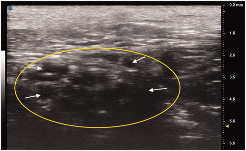 Figure 3. Patient’s deteriorated right median nerve at the wrist crease. Oval indicates cross section of the median nerve. White arrows point to individual nerve fascicles.