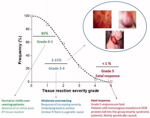 Figure 2. Grade assessment for distribution of responses to Radiotherapy. Radiotherapy doses are chosen to ensure that the majority (at least 85%) of patients display no or minor post-RT tissue reactions. Such patients are defined as showing grade 0-1 reactions. Some patients (up to 15%) show moderate tissue complications that can cause moderate to severe discomfort. Such patients fall into grade 2-3/4 responses). A small subset of patients display a severe response, which for a grade 5 response can be fatal. Patients with mutations in the genes that function in DNA non-homologous end-joining or the ATM-signaling pathway can fall into this category. The precise percentage of patients that are considered to be RS differs slightly between countries and/or departments/hospitals. Particularly critical is the assessment of whether a grade 2 response lies within the normal or RS range. Here, we have placed a grade 2 response as being within the RS category. We give the percentage of RS individuals as ∼15%, which represents an average of estimates presented in the literature.