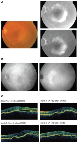 Figure 2 A 75-year-old female patient with previously untreated advanced age-related macular degeneration in the right eye received pegaptanib every 6 weeks for 3 injections. A) Fundus photograph at baseline (left panel) and fluorescein angiography (right panel). B) Indocyanine green angiography at baseline and 6 months. C) Optical coherence tomography images and visual acuity (VA; Early Treatment Diabetic Retinopathy Study [ETDRS] letters) at baseline and months 1, 3, and 6.