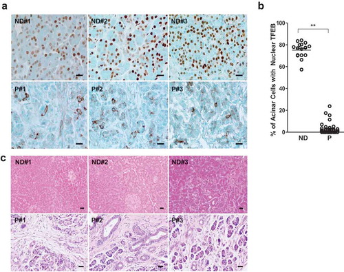 Figure 9. Decreased acinar cell nuclear TFEB staining in human pancreatitis samples. (a) Representative images of TFEB immunohistochemistry staining in normal donor (ND) and pancreatitis patients (P) tissues are shown. Bar: 20 μm. (b) The number of cells with nuclear TFEB staining were counted in each group (N = 16 for ND; n = 45 for P). Data are mean ± SE and at least 6 images were counted in each sample. **: p < 0.01 by Student t test. (c) Representative H&E staining images of pancreas from ND and P are shown. Numbers of 1, 2, 3 represent 3 different human samples. Bar: 20 μm.