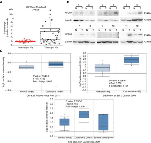 Figure 1 mRNA and protein expression levels of KIF20A in gastric cancer tissues and the corresponding normal tissues.Notes: (A) Relative mRNA expression of KIF20A was detected by quantitative real-time PCR and is shown in box and whisker plot. (B) Protein expression of KIF20A was estimated by Western blot assay. 1–12 correspond to 12 samples from GC patients. (C) Three mRNA expression profiles of KIF20A in gastric carcinoma and normal tissuesCitation27–Citation29 were extracted from Oncomine and are presented as a box and whisker plot.Abbreviations: N, normal control; T, tumor tissue.